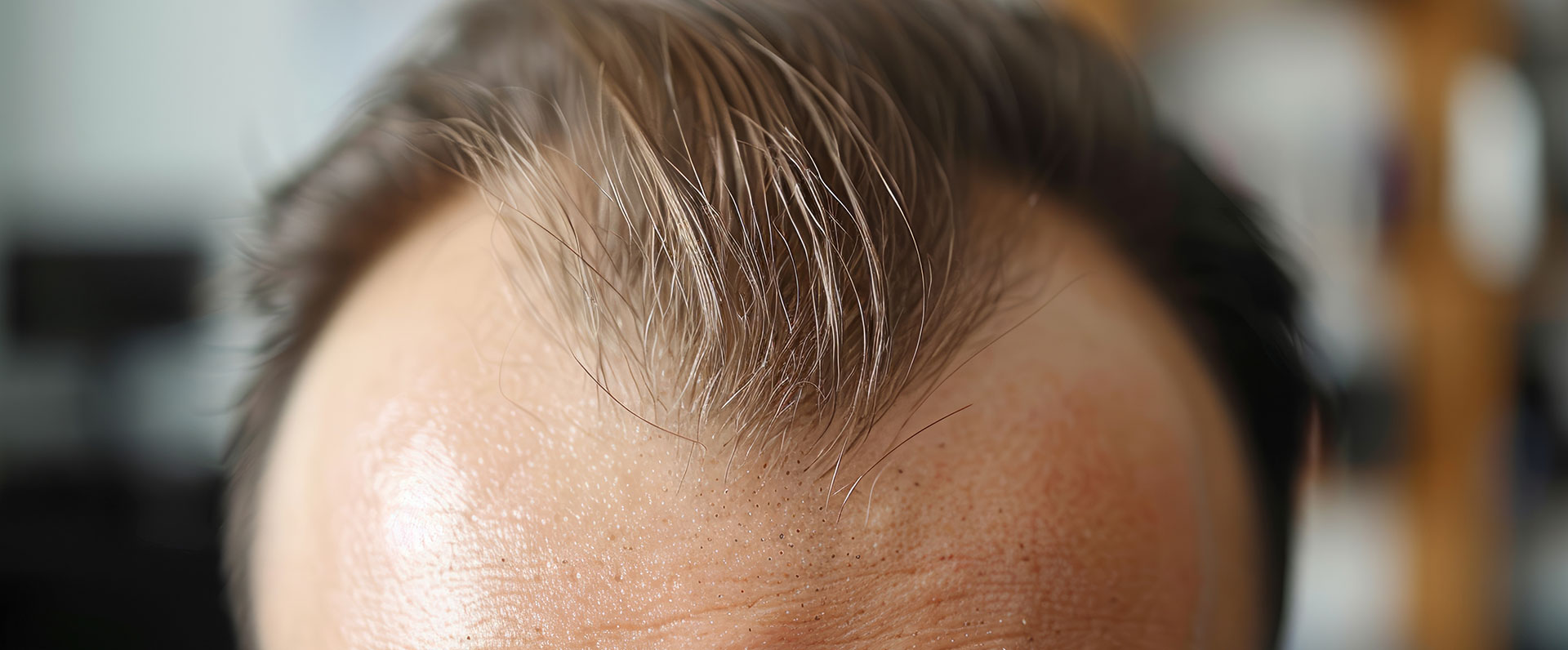 Hair Replacement Services